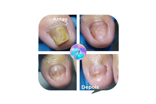 Foto de antes e depois do tratamento 41